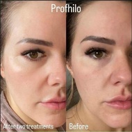 THE BEST SKINBOOSTER PROFHILO