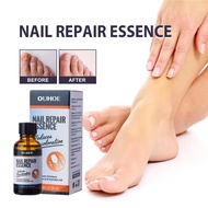 OUHOE Nail Repair Essence Nail Fungal Essence Feet Care Nail Fungus Serum Infection Onychomycosis Be