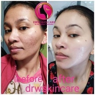 Radiant Acne brightening Drw skincare/Acne Glowing/Acne scar Cream