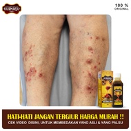 Obat Prurigo Amis Daging Gatal Luar Dalam Kulit Koreng Radang Kulit Ruam Bentol Bentol Bekas Gigitan