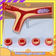 【W】Human Atherosclerosis Cardiovascular Model Vascular Anatomy Model Branch Atherosclerosis Teaching