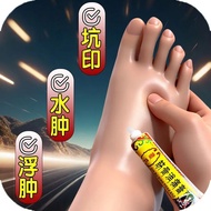 Hot Sale Legs Foot Edema Lower Limbs Edema Elderly Foot Edema Limbs Edema Instep Edema Difficult Wal