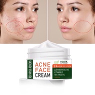 VOVA ACNE FACE CREAM acne treatment Acne remover acne remover acne treatment acne halang acne growth