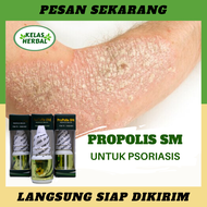 Obat untuk Psoriasis - Obat Minum Psoriasis - Obat Herbal Tetes Psoriasis - Obat Penyakit Kulit Psor