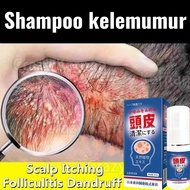 Seborrheic Dermatitis Spray 30ml Scalp Treatment Scalp Psoriasis Anti Dandruff Ubat Kulit Kepala Ber