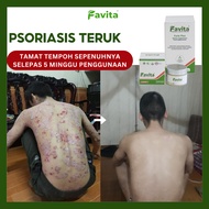 Krim Anti-gatal Favita, Krim Herba, Krim Ekzema, Krim Psoriasis, Krim Gatal, Rawatan Kulit Gatal, Ji
