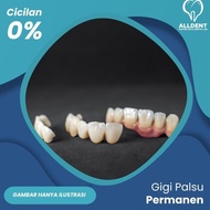 Gigi Palsu Permanen Crown