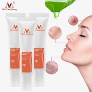 MeiYanQiong 3 loại gel trị mụn với tinh chất thảo dược trị sẹo mụn-INTL