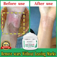 ALIVER scar remover for old scar on leg 50ml, Peklat Remover Cream Original, Pantanggal ng pellet, S