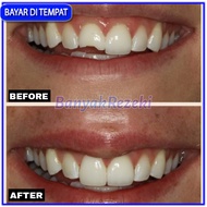 [ 2 PCS/BUNGKUS ] Penambal gigi ompong permanen Penutup gigi berlubang Gigi palsu penambal ompong gi