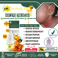 Propolis SM - Obat Gatal Gatal Biang Keringat Ruam Popok Bayi - Obat Ruam Merah Lupatan Leher 100% H