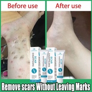 Scar removal cream Krim hilangkan parut hitam Hilangkan parut kudis Hilangkan parut lama Parut kaki 