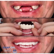 DENTAL Paket gigi palsu atas bawah snap on smile Gigi Palsu Atas Murah
