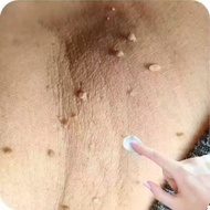 skin tag remover curesys acne patch ellgy corn and warts wart removal patch genital warts removal cr