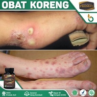 Obat Koreng Bernanah - Obat Gatal Koreng Bernanah - Obat Koreng Di Kaki - Obat Koreng Di Kepala - Ob