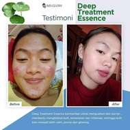 Deep Treatment Essence/Essence MsGlow