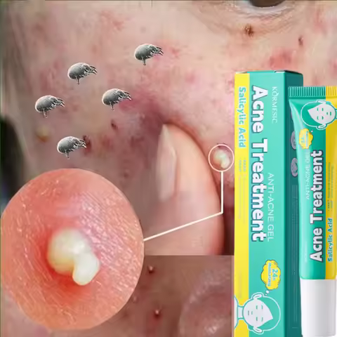Salicylic Acid Acne Cream Fast Gently Repair Acne Spot Scar Shrinks Pores Gel Brightens Skin Tone Ti