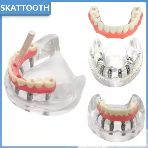 Dental Implant Model with Implant Overdenture Inferior Lower Tooth Implant Removable Model for Denti