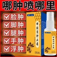 Hot Sale best seller Edema reducing Edema Floating Edema Elderly Leg Edema Heart Source Edema Draina