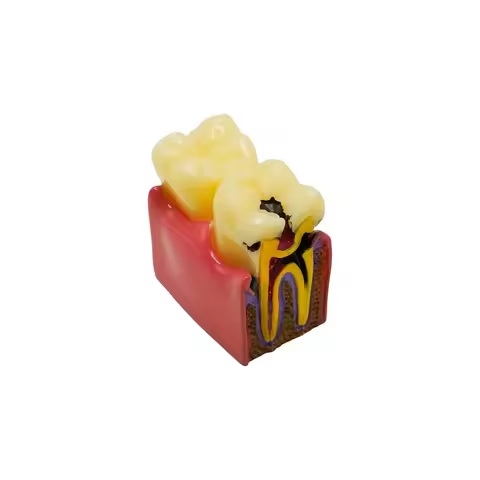 1set Dental Caries Comparsion Tooth Models 6 Times Study Models for Dentist Studying Teaching Anatom