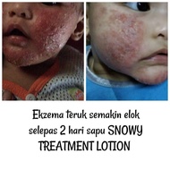 treatment lotion (ezema/kurap)