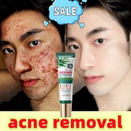 Acne cream Acne Treatment ubat jerawat dan parut Krim Jerawat Muka Punggung Acne Scar Fast Removal a