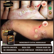 Drug For Itching, Medicine For Itching Budugan, Medicine For Itching Scabies, Medicine For Hand Stra