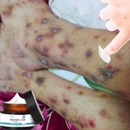 krim hilangkan parut hitam Hilangkan parut kaki Hilangkan bekas luka lama Hilangkan parut kudis Mosq