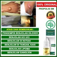 Obat Pengempis Benjolan Benjolan Dileher Benjolan Uci Uci Benjolan Lipoma Ganglion Benjolan Di Ketia