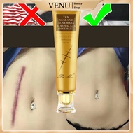 Scar Removal Cream Treatment Remove Stretch Marks Acne scar serum repair cream