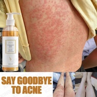 Eczema Body Wash Baby Eczema Acne Body Wash for Sensitive Skin Whitening Eczema Shower Gel Moisturiz