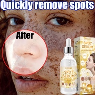 【Only 7 days】Anti-freckle essence effectively removes freckles, chloasma, age spots, dark spots, sun