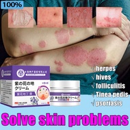 Eczema cream krim gatal antifungal cream psoriasis cream 30g Herbal antibacterial cream eczema relie
