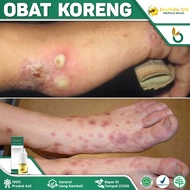 Obat Koreng Bernanah - Obat Koreng Bernanah Di Kaki - Obat Oles Koreng Bernanah - Obat Salep Koreng