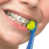 Curaprox Ortho Kit braces