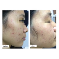 (BOX ONLY) FUSKIN Herbal Acne Pimple Cream “肤” 祛痘膏 痘痘膏 Krim Jerawat Acne Cream Treatment For Sensiti