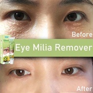 20g milia remover eye cream krim milia seed remover biji kolestrol remover syringoma fat granule rem