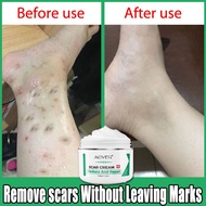 ALIVER Scar Removal Cream Remove Scar Gel Acne Scars Treatment Acne Scar Remover 50ML