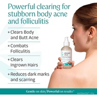 new AlmondClearMandelicAcidLevel2Serum–ExtraStrengthTreatmentforBodyAcne,Folliculitis,andIngrownHair