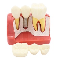 Model Gigi Alat Peraga Gigi Implant Analysis Crown Bridge Demonstrasi 4 Kali