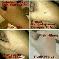 || PROMO ~`~ Peeling TCA Gel 40% - Peeling Badan - Pemutih Tubuh - Pengelupasan ||~~~