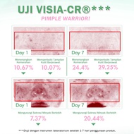 BNB barenbliss Pimple Warrior Salicylic Acid Acne Drying Lotion - Acne Spot Treatment Care