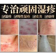 纯中草药配方湿疹膏皮痒Eczema Cream