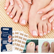 EELHOE Toenail Correction Ingrown Nail Correction Repair Toenail Manicure Nail Correction