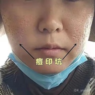 [Ready stock] acne cream【去印不留痕】去痘印去痘坑痘疤祛痘膏黑色凹洞素修复毛孔抗痘膏
