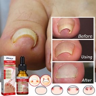 ubat kuku rosak ingrown toenail nail fungus treatment ubat kuku cekam toenail corrector paronychia p