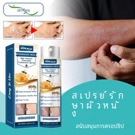 Bee Venom Psoriasis Treatment สเปรย์กลาก Eczematoid Antibiotic บรรเทาอาการคันผิวหนัง Desquamation โร