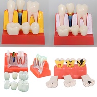 4 Times Dental Implant Explanation Model Oral Dental Model Removable Crown Implant Display Model Doc