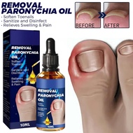 Ingrown Toenail Corrector Curve Correct Ingrown Toenail Softener Discomfort Reliever Safe Ingrown To