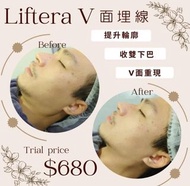 Liftera V 面埋線療程 提升輪廓 收雙下巴